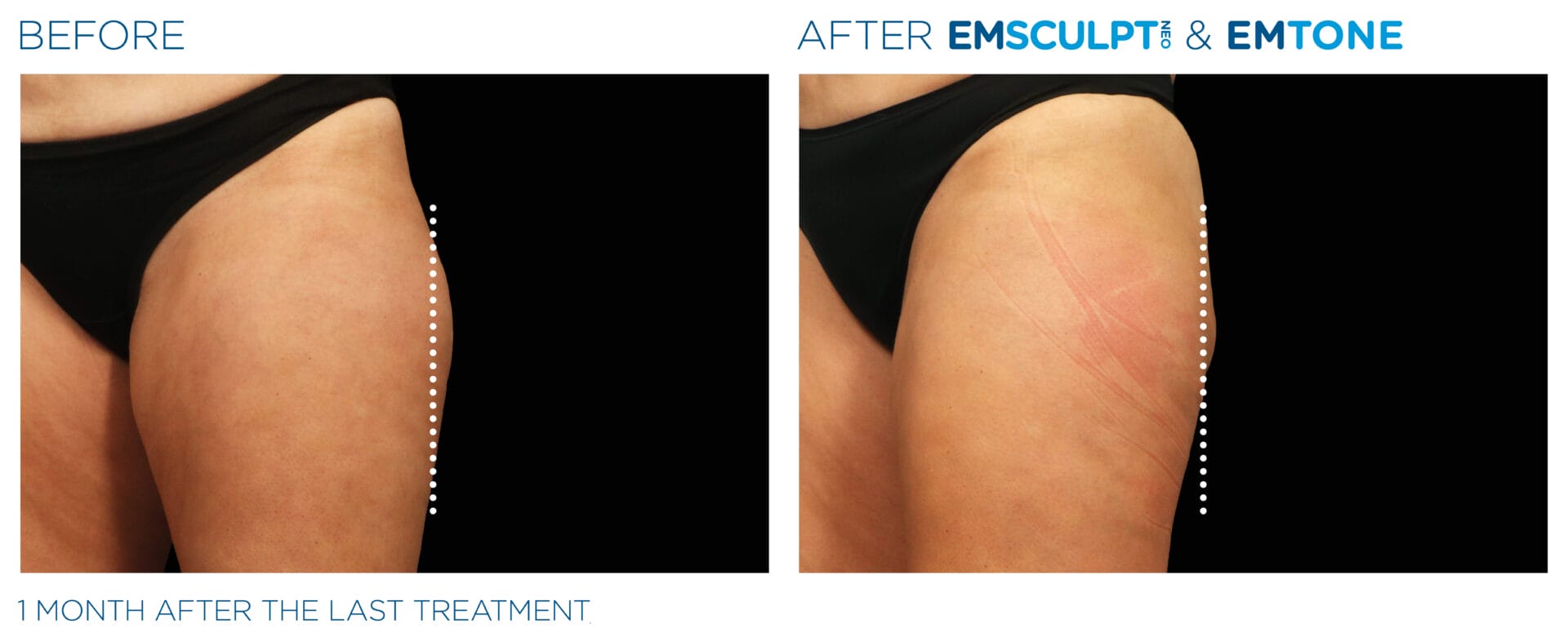 CoolSculpting® in Portland, Orgeon